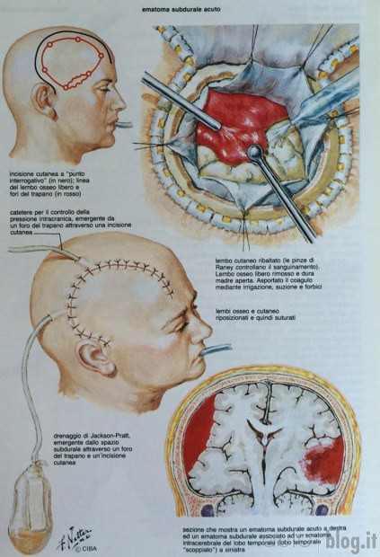 ematoma subdurale che collega le vene